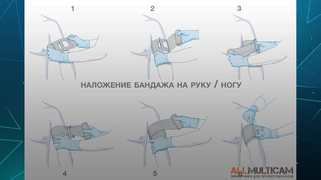 НАЛОЖЕНИЕПОВЯЗОК