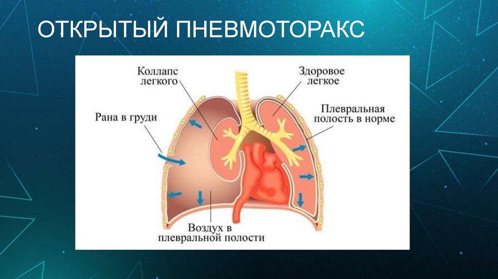 ОТКРЫТЫЙ ПНЕВМОТОРАКС