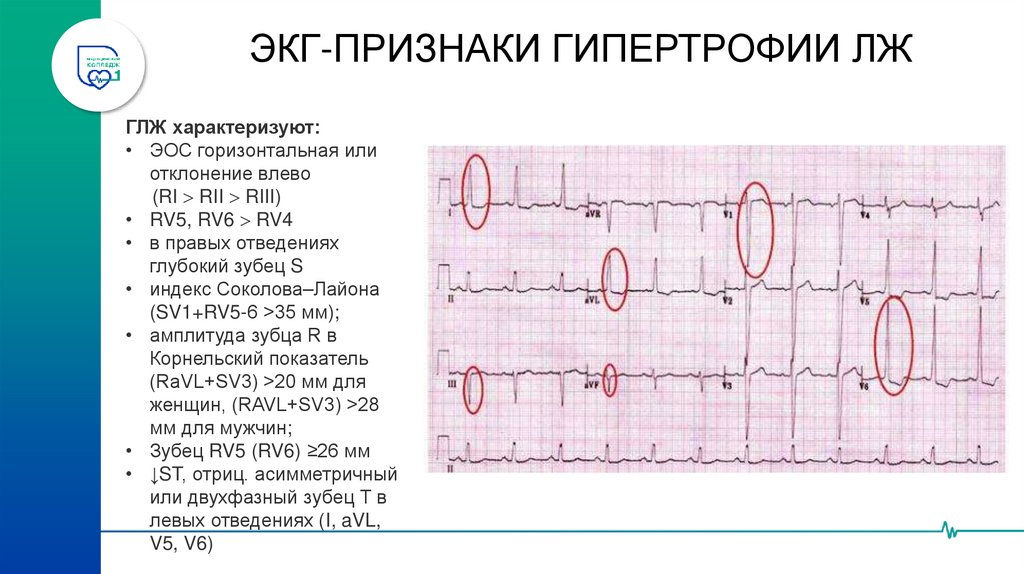 ЭКГ-ПРИЗНАКИ ГИПЕРТРОФИИ ЛЖ