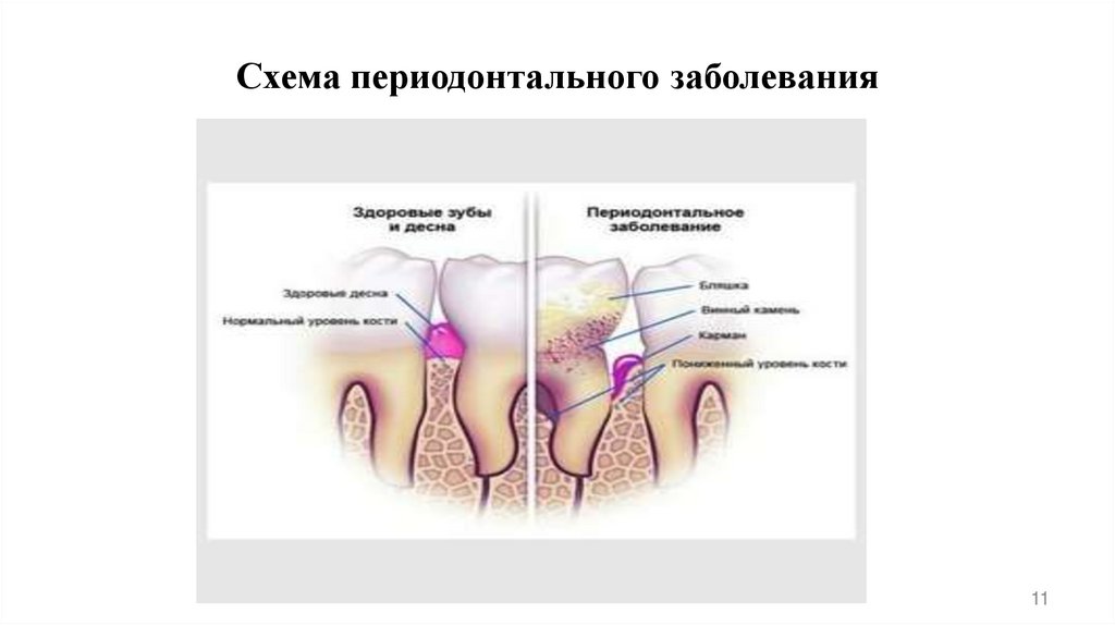 Схема периодонтального заболевания