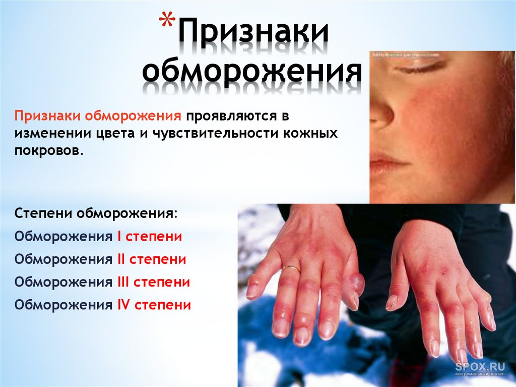 Признаки обморожения
