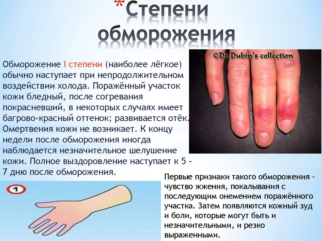 Степени обморожения