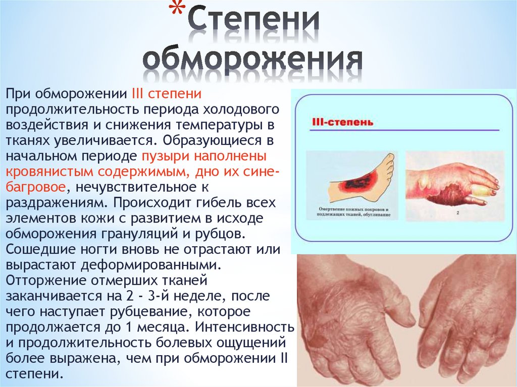 Степени обморожения
