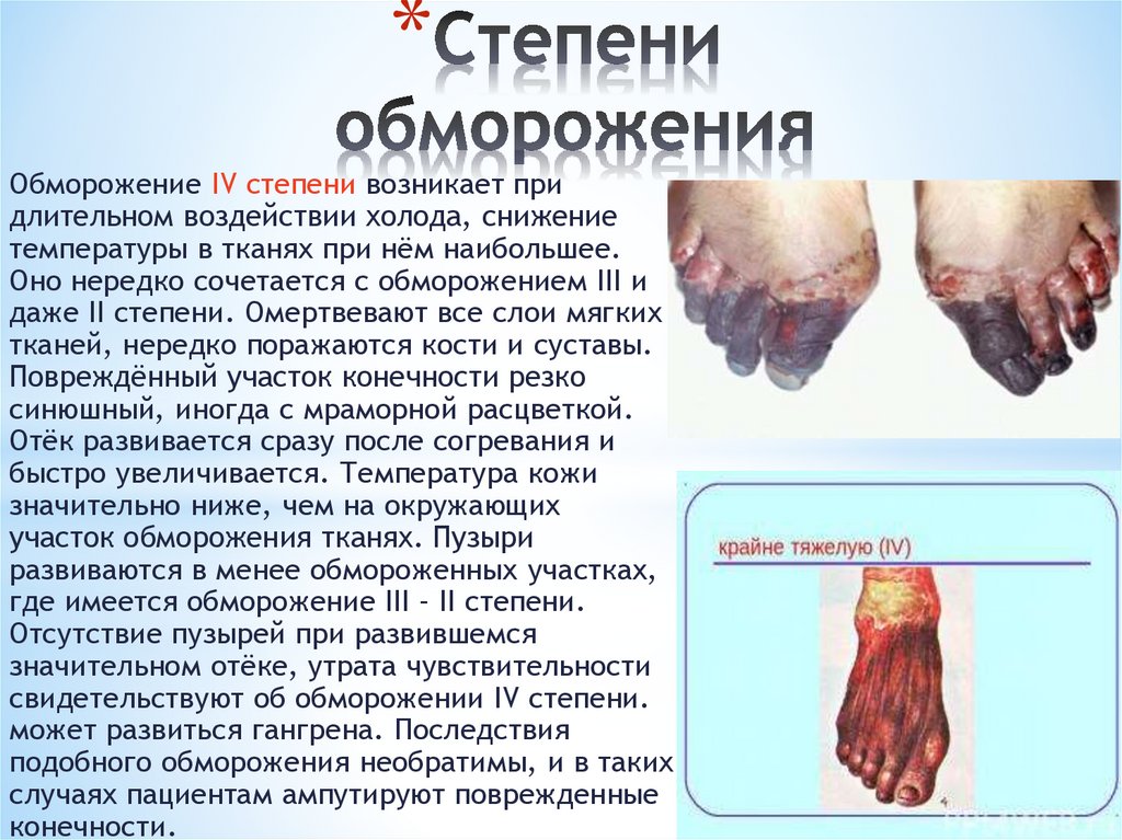 Степени обморожения