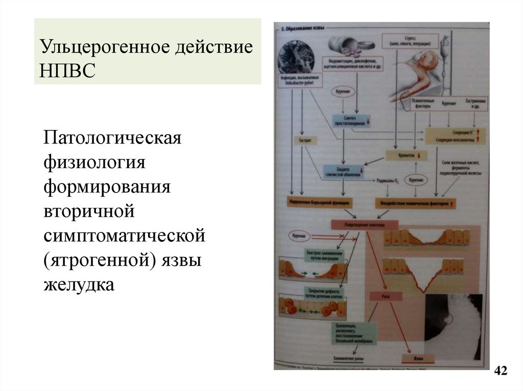 Ульцерогенное действие НПВС
