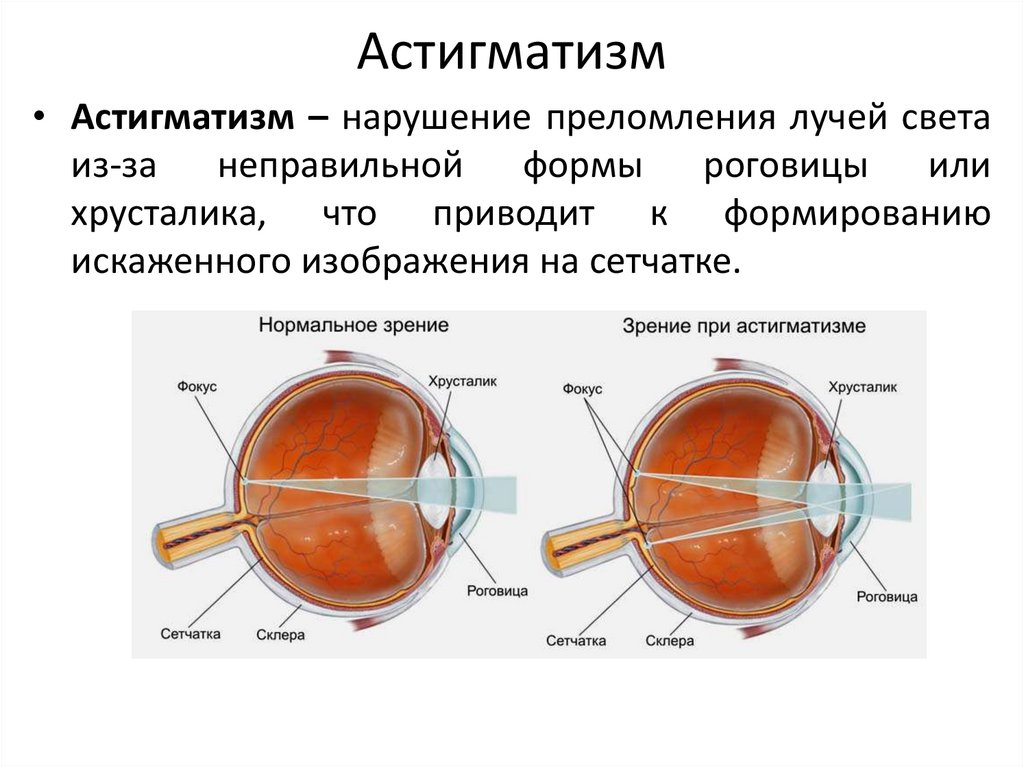 Астигматизм