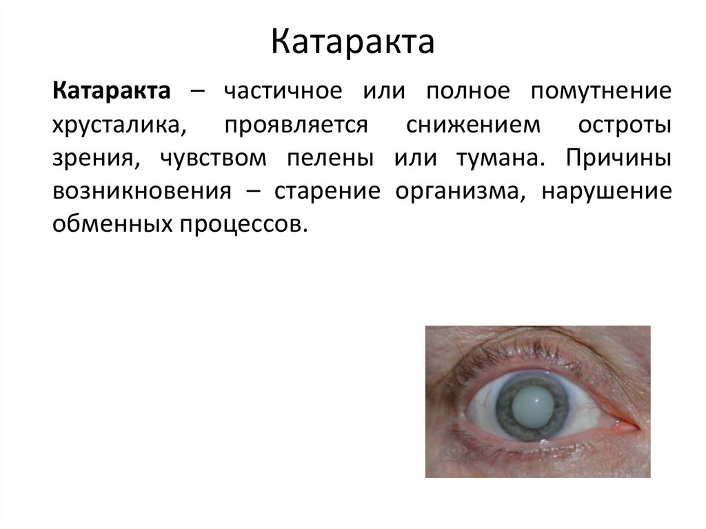 Катаракта