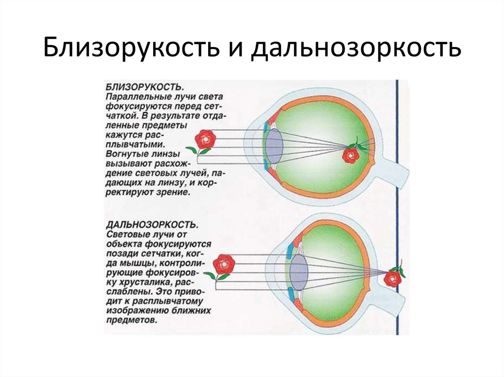 Близорукость и дальнозоркость