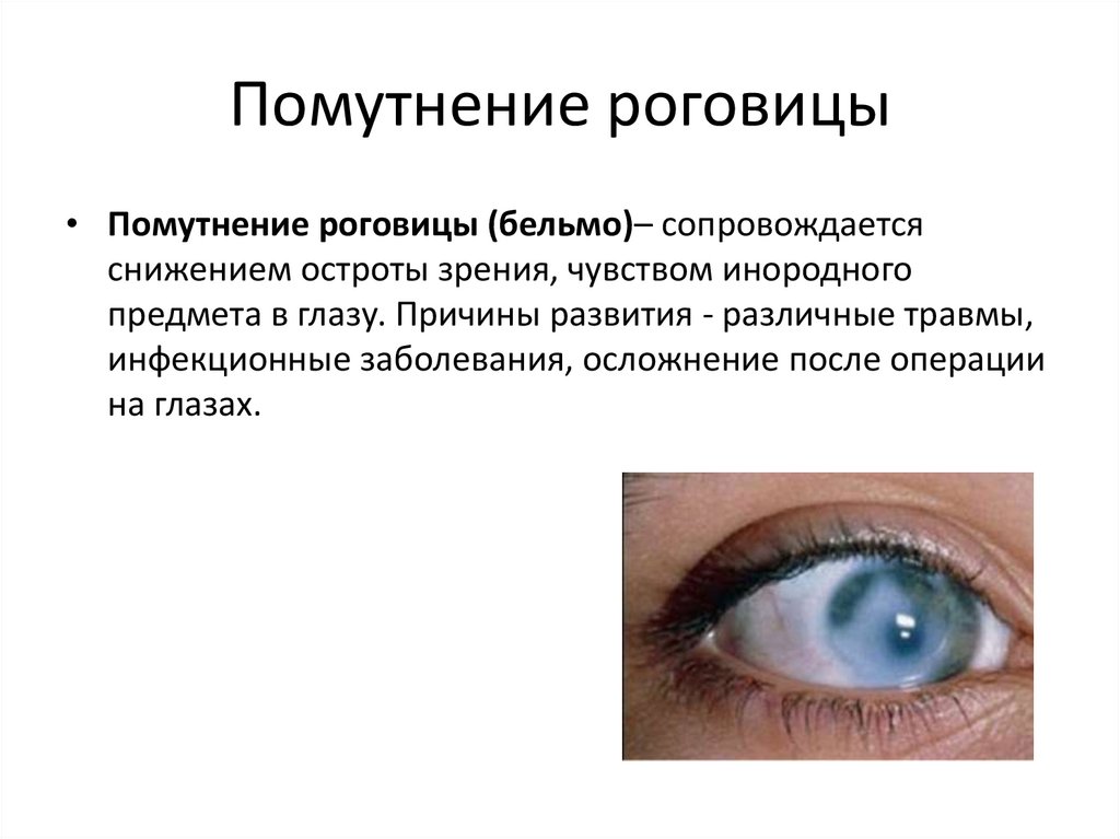 Помутнение роговицы
