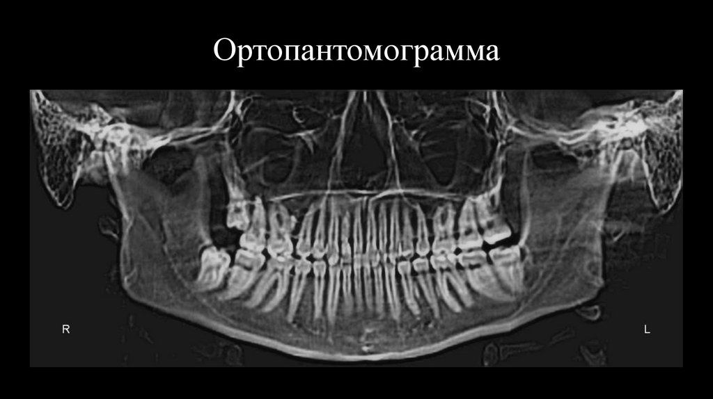 Ортопантомограмма