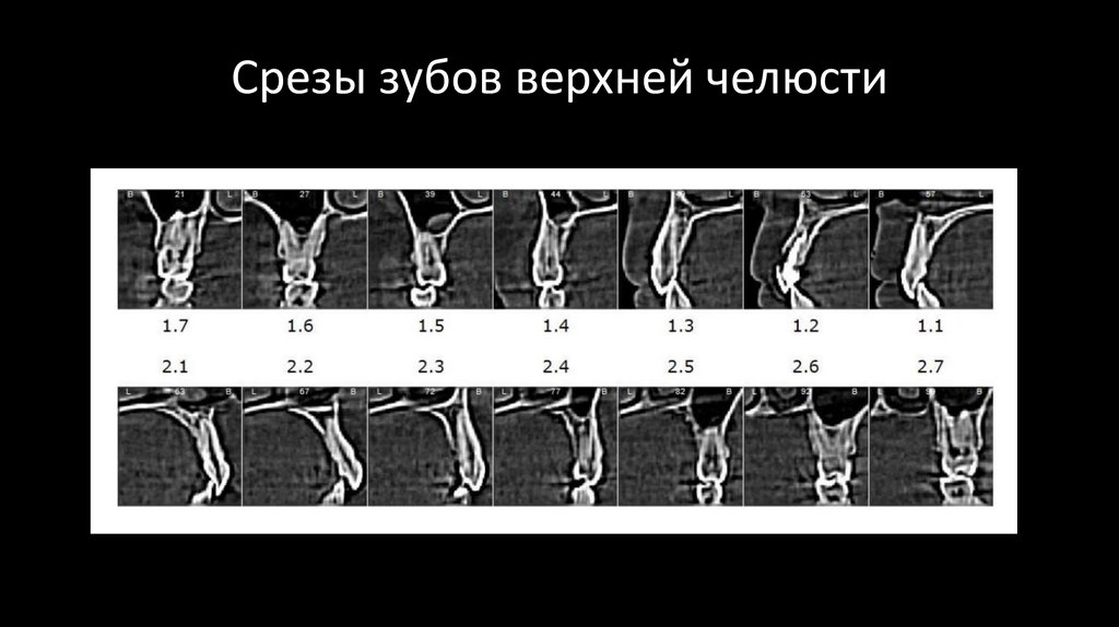 Срезы зубов верхней челюсти