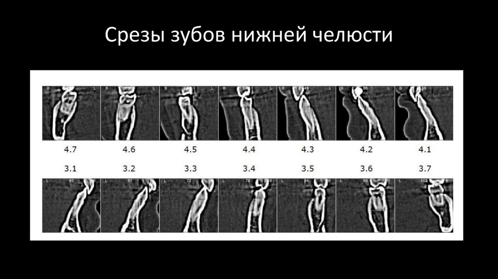 Срезы зубов нижней челюсти