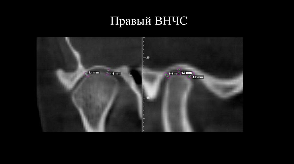 Правый ВНЧС