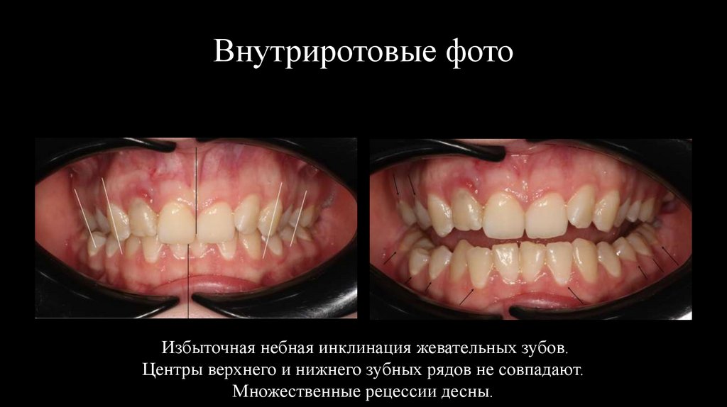 Внутриротовые фото