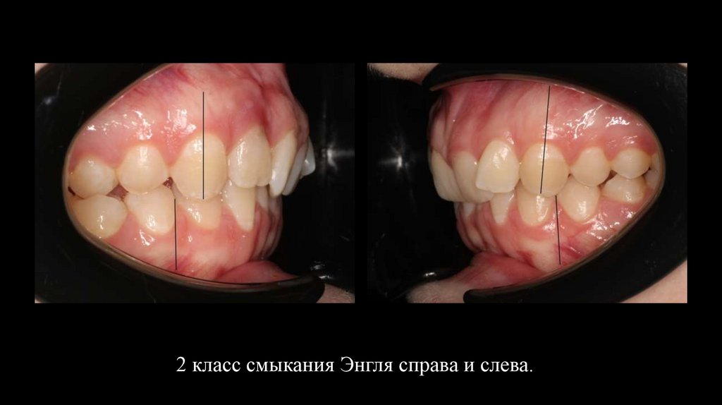 2 класс смыкания Энгля справа и слева.