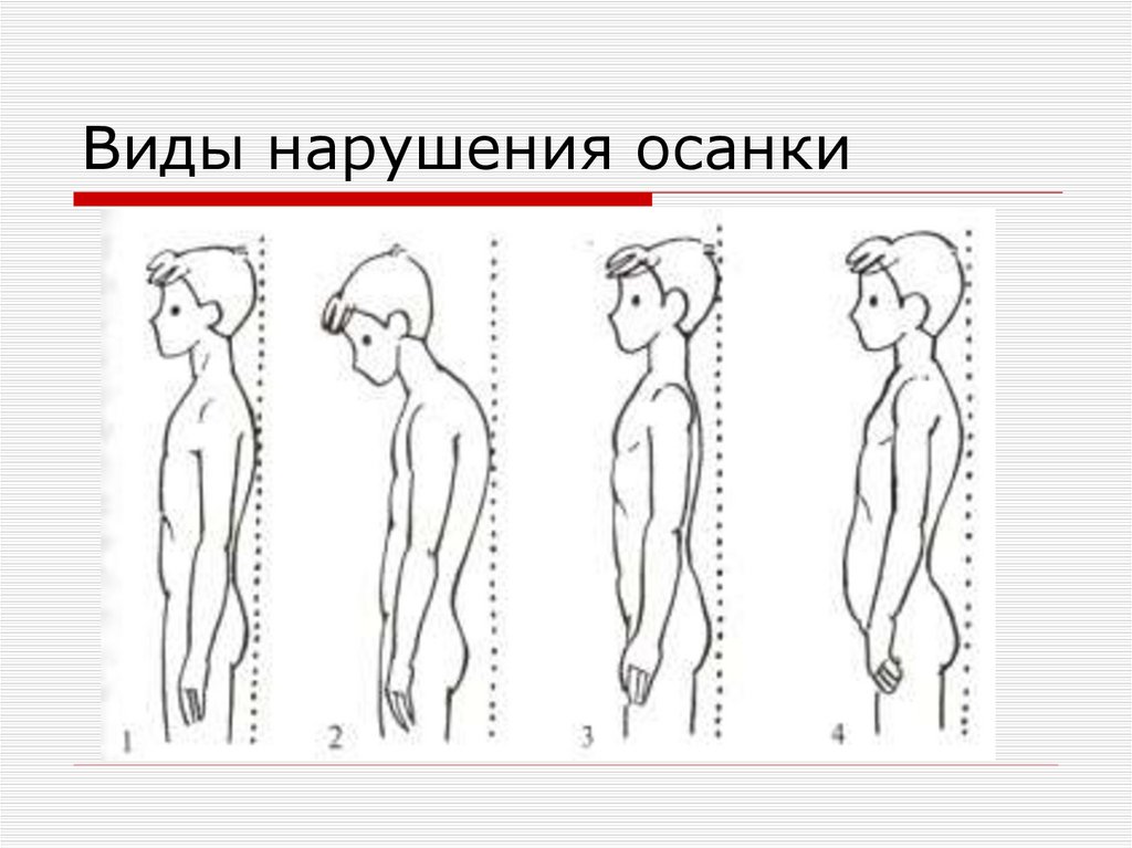 Виды нарушения осанки
