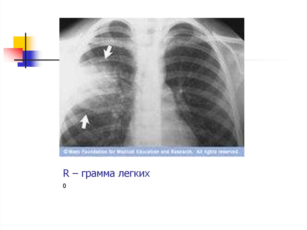 R – грамма легких