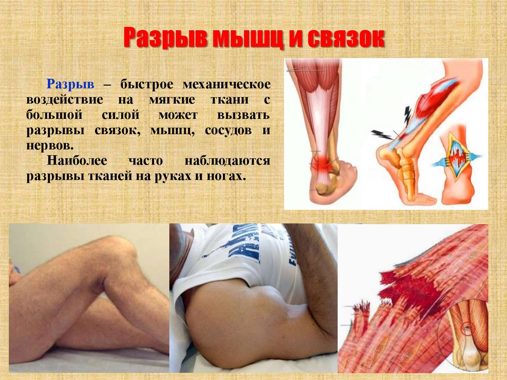 Разрыв мышц и связок