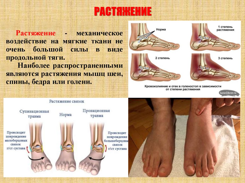 РАСТЯЖЕНИЕ