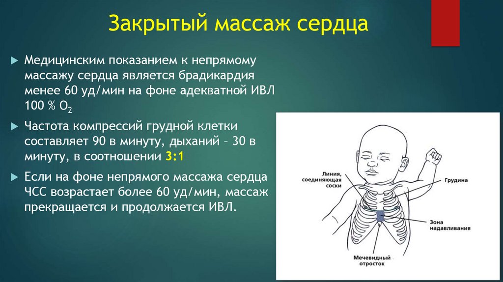 Закрытый массаж сердца