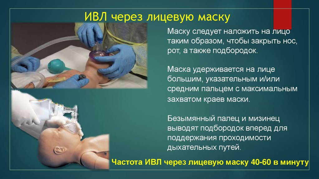 ИВЛ через лицевую маску