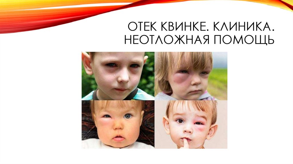 Крапивница у детей. Неотложная помощь