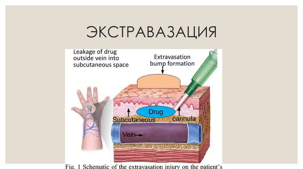 ЭКСТРАВАЗАЦИЯ