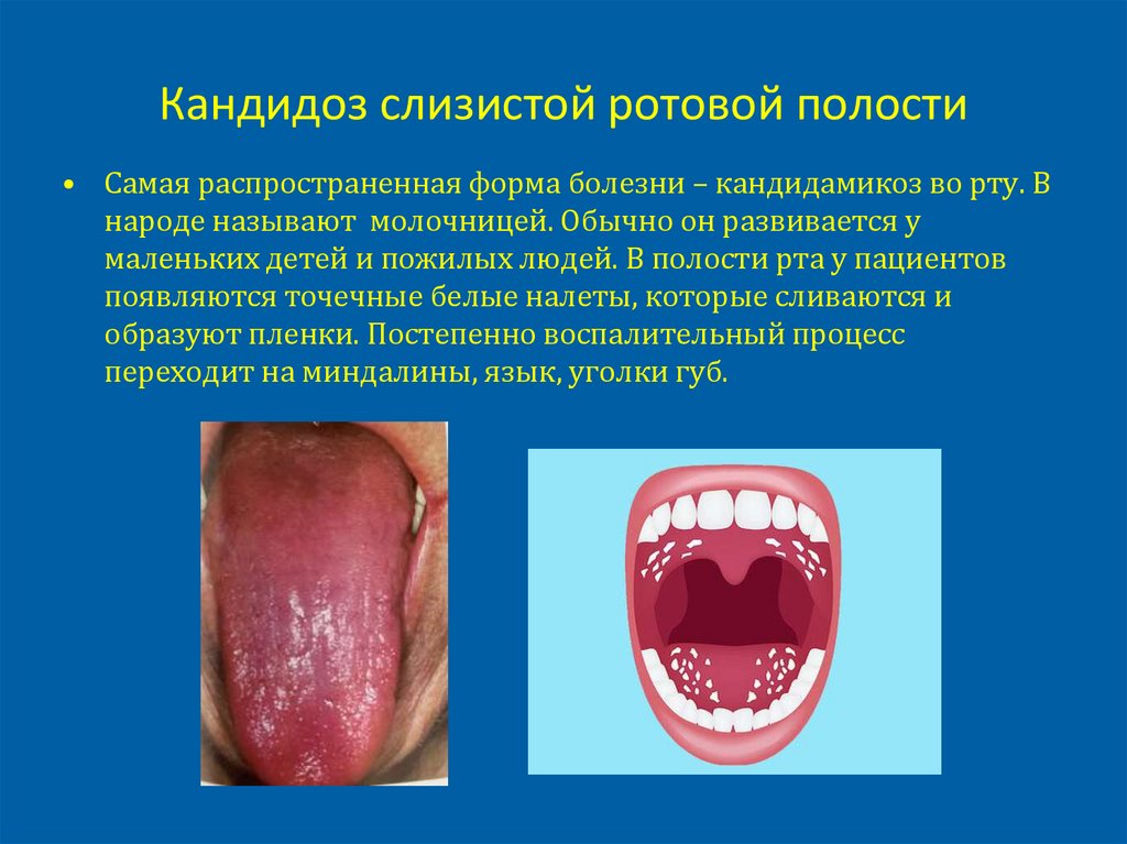 Кандидоз слизистой ротовой полости