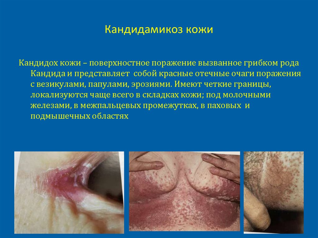 Кандидамикоз кожи