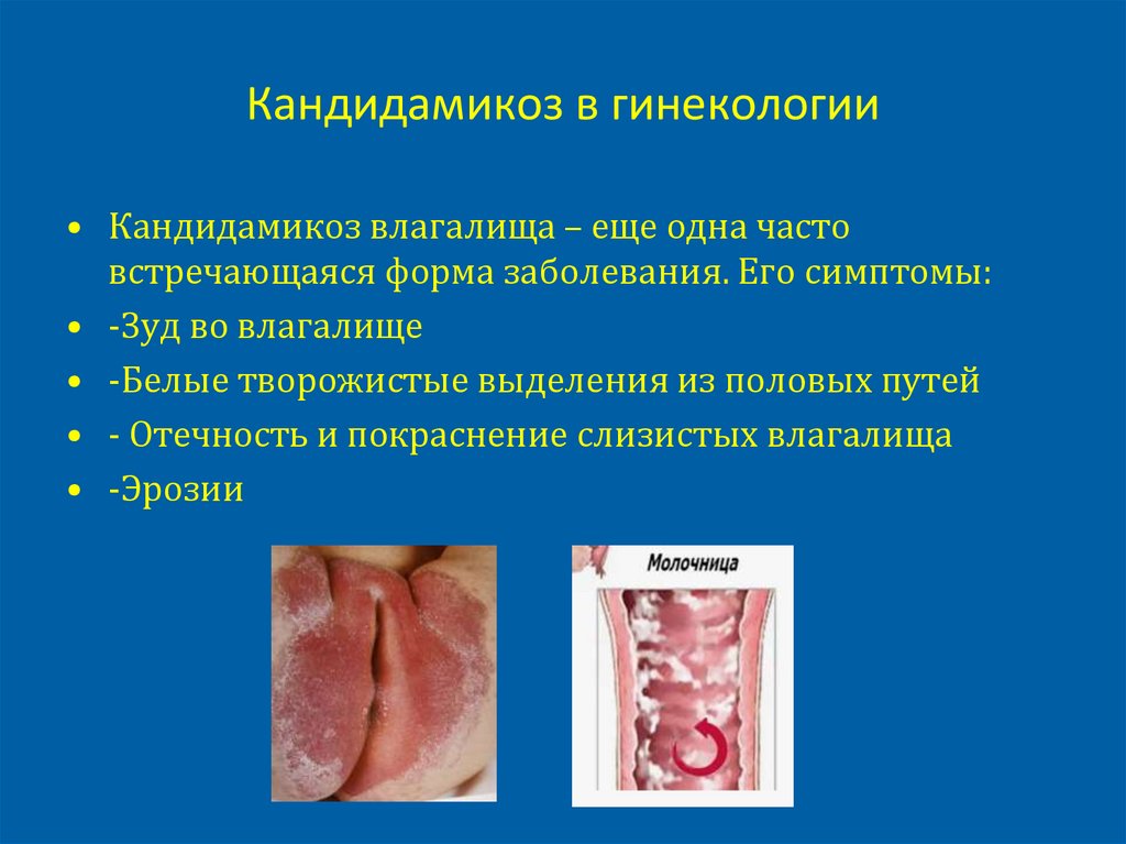 Кандидамикоз в гинекологии