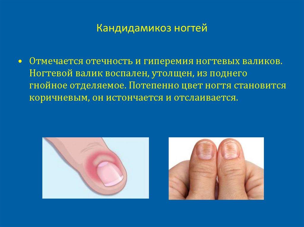 Кандидамикоз ногтей
