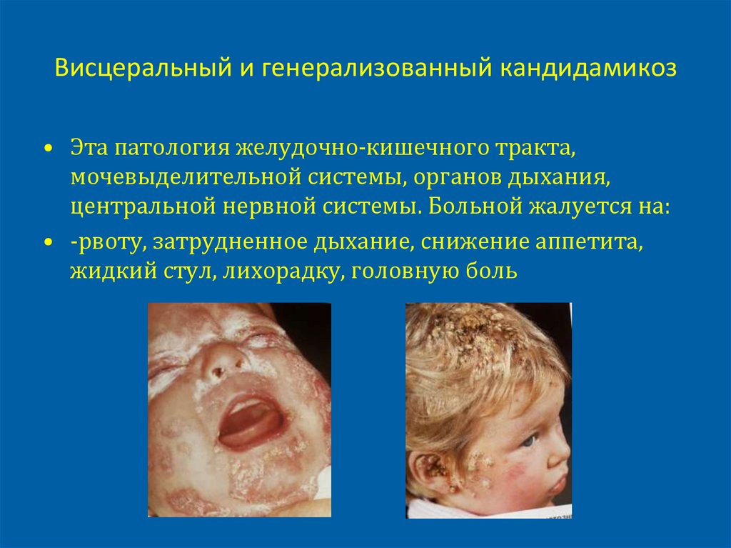 Висцеральный и генерализованный кандидамикоз