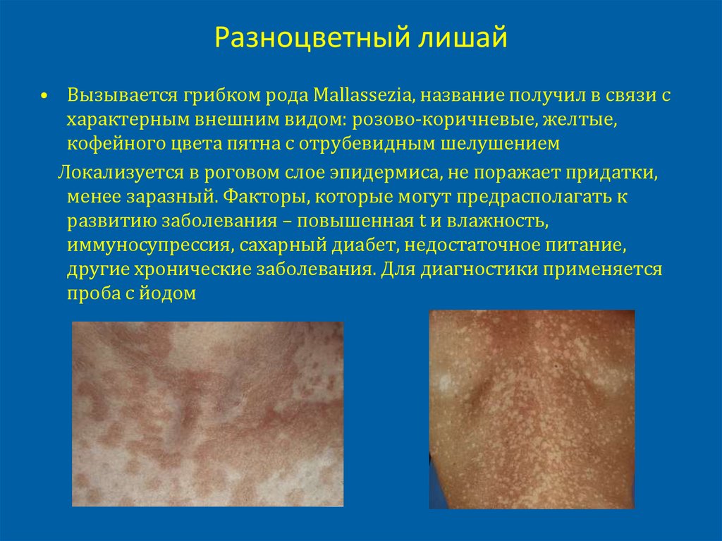 Разноцветный лишай