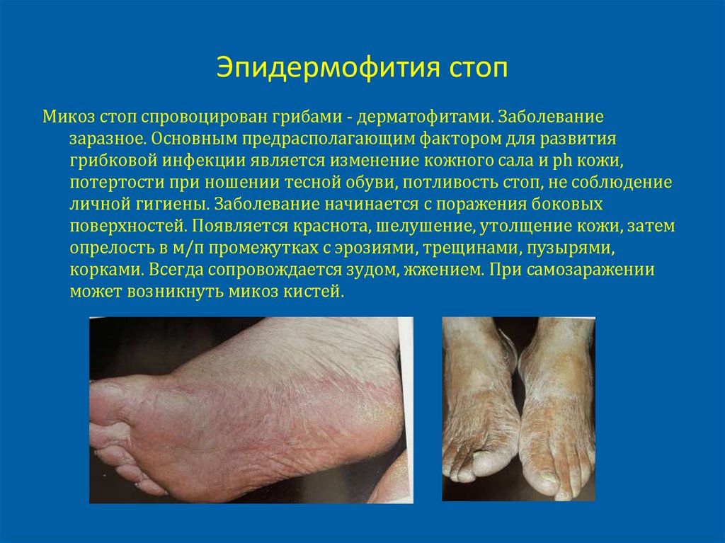 Эпидермофития стоп