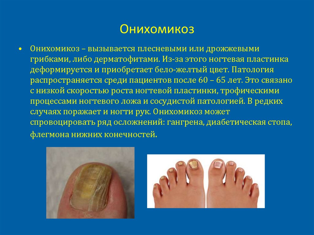 Онихомикоз