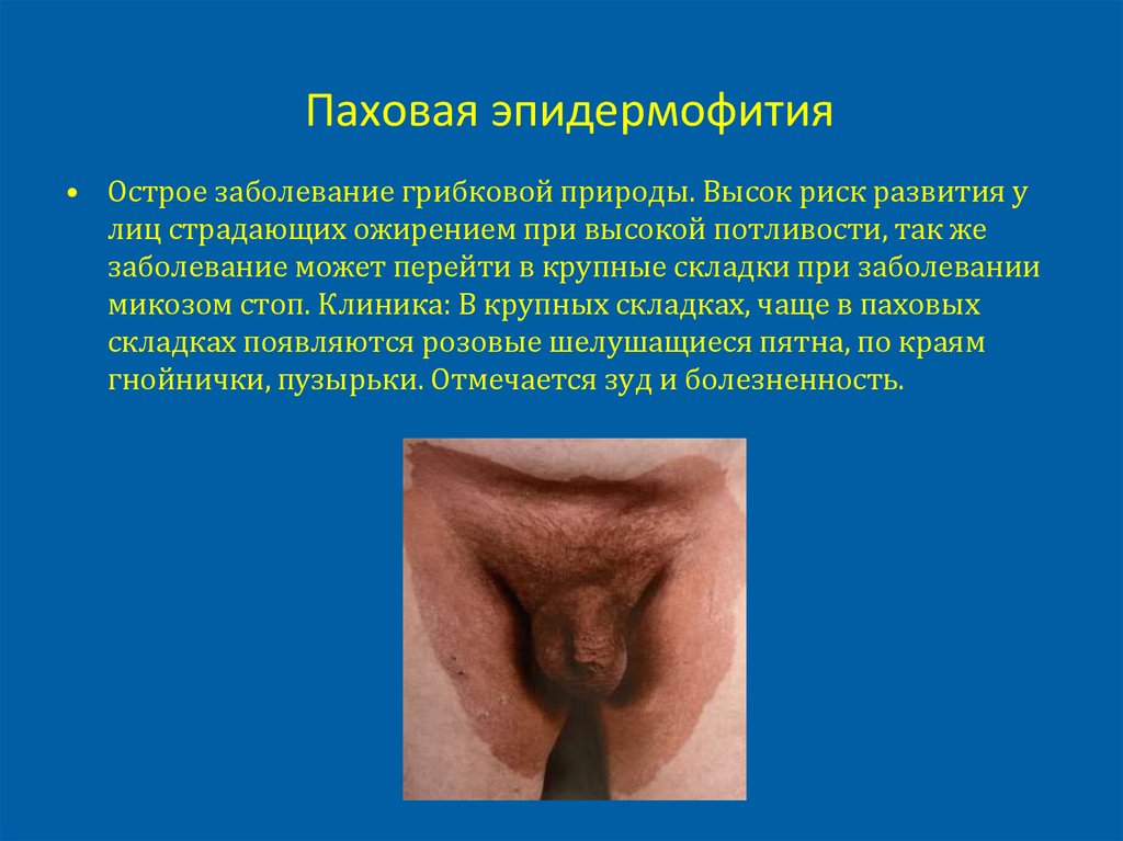 Паховая эпидермофития