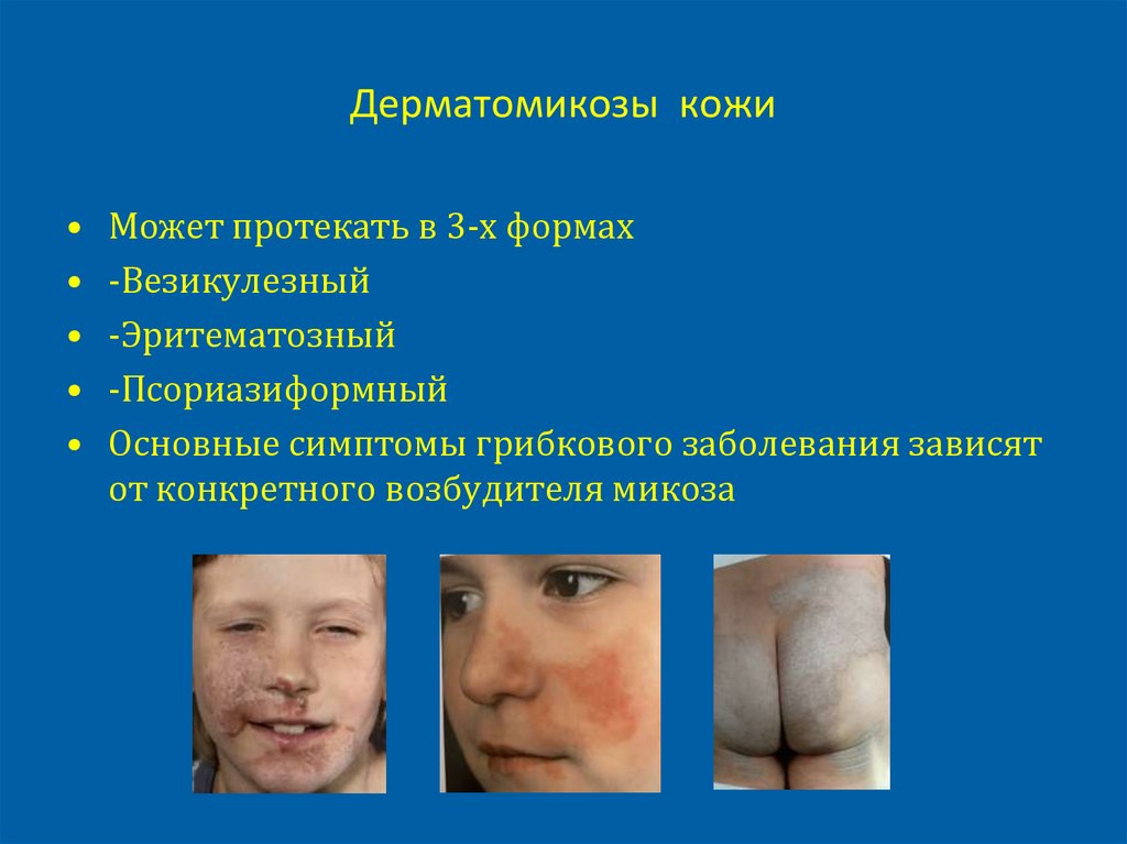 Дерматомикозы кожи
