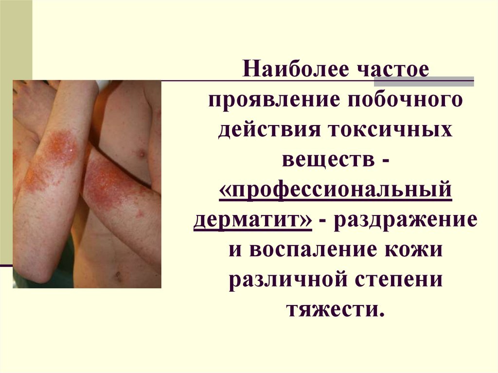Наиболее частое проявление побочного действия токсичных веществ - «профессиональный дерматит» - раздражение и воспаление кожи