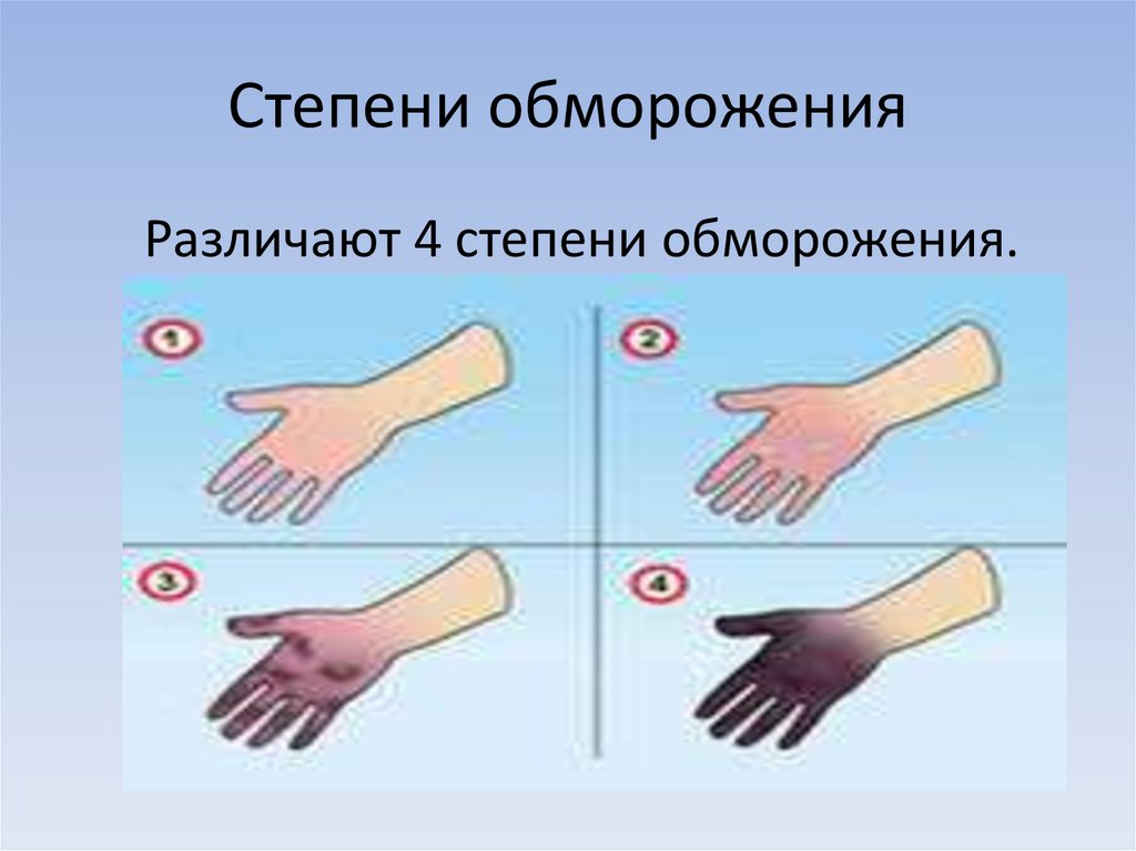 Степени обморожения
