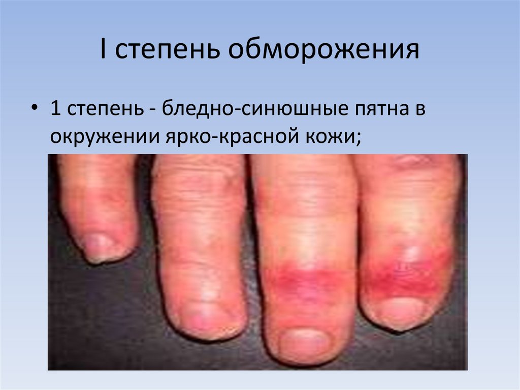 I степень обморожения