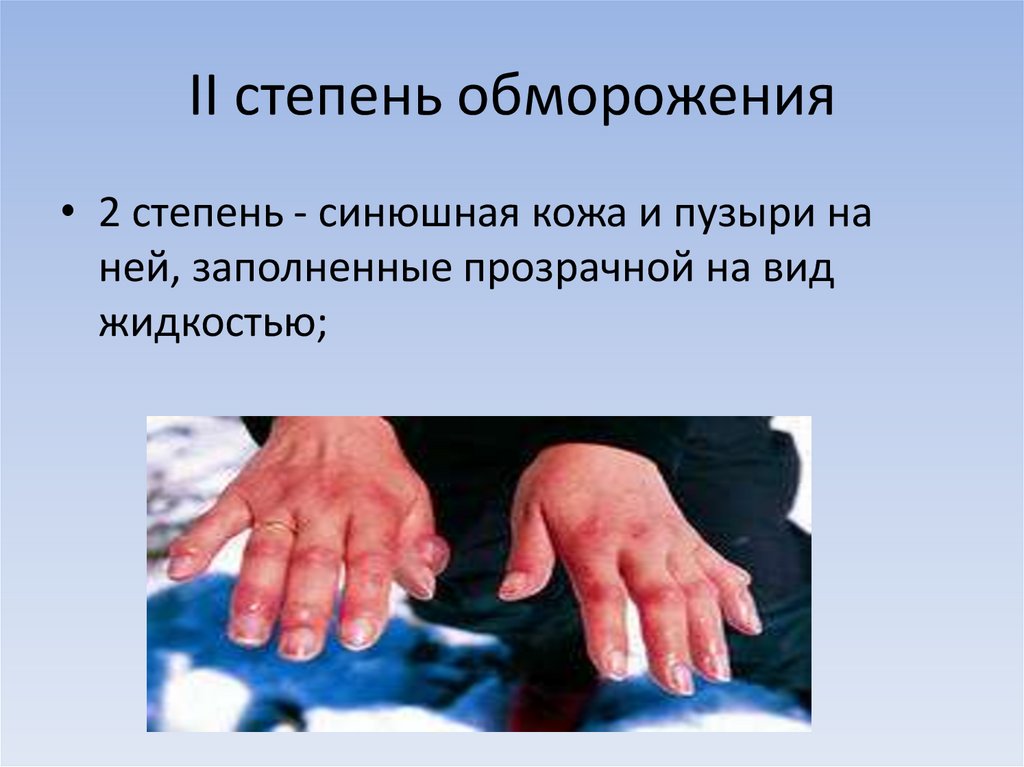 II степень обморожения
