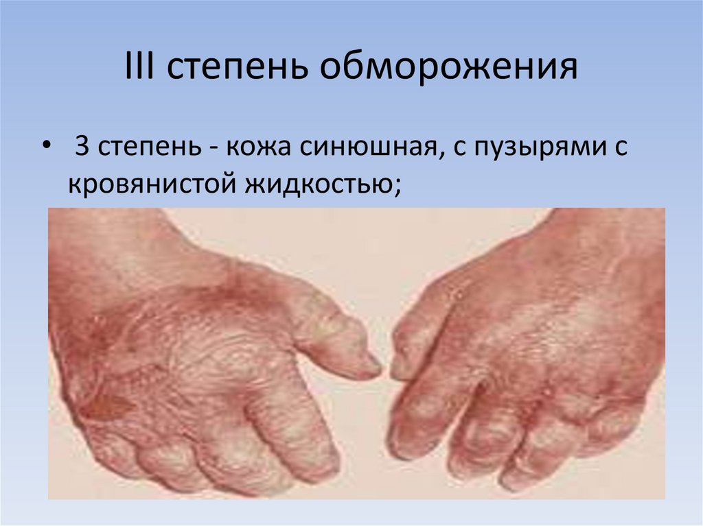 III степень обморожения