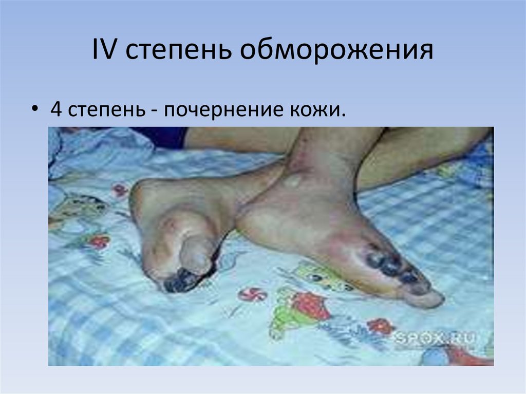 IV степень обморожения