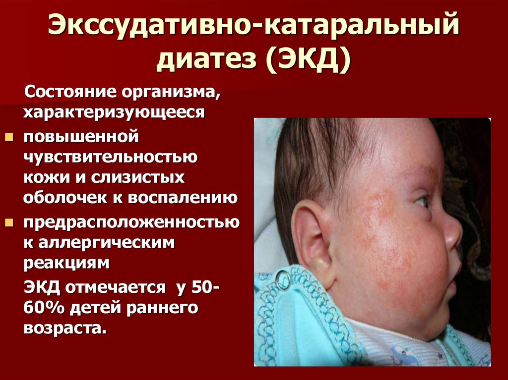 Экссудативно-катаральный диатез (ЭКД)