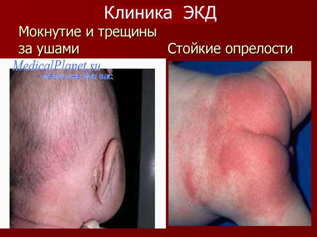 Мокнутие и трещины за ушами Стойкие опрелости