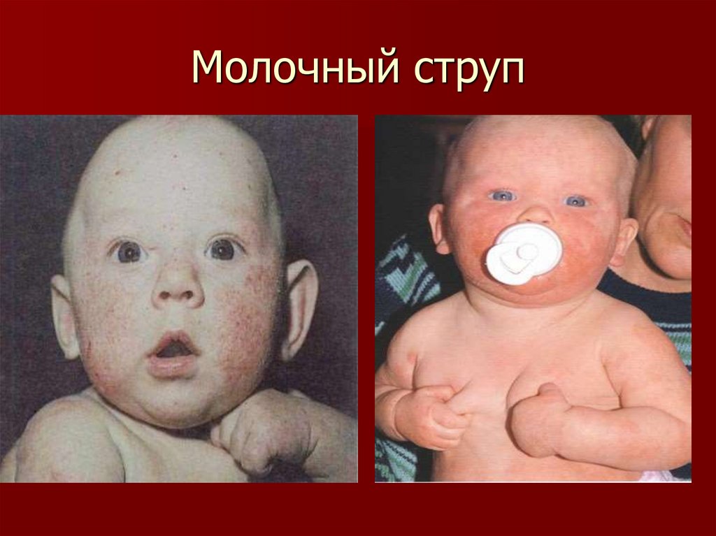 Молочный струп