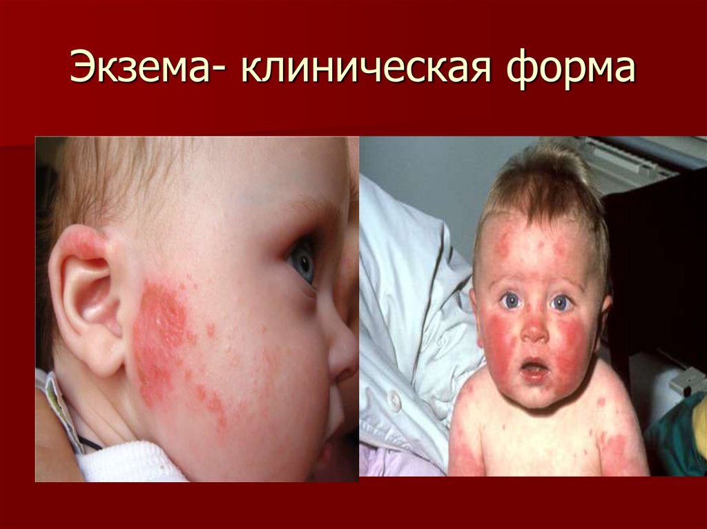 Экзема- клиническая форма