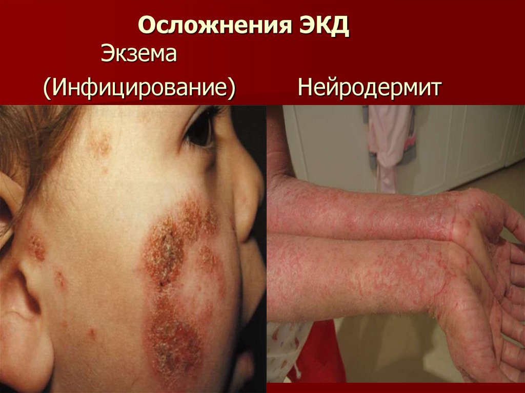 Осложнения ЭКД Экзема (Инфицирование) Нейродермит