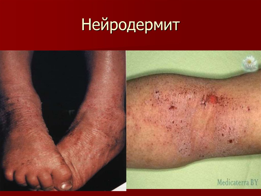 Нейродермит