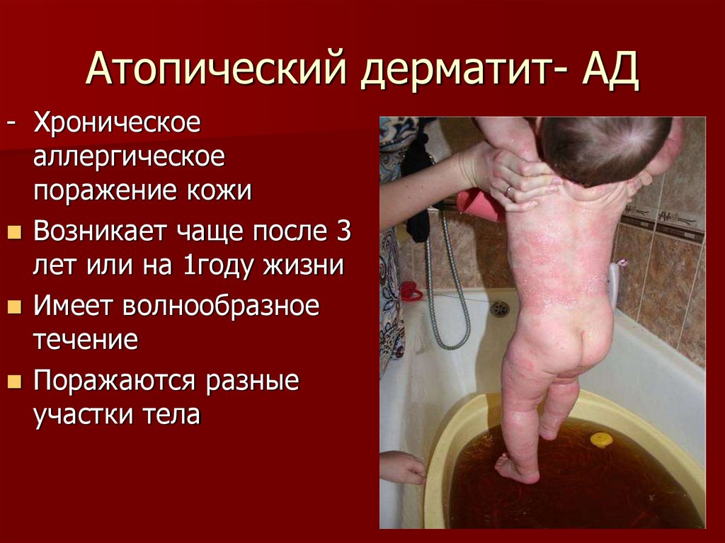 Атопический дерматит- АД